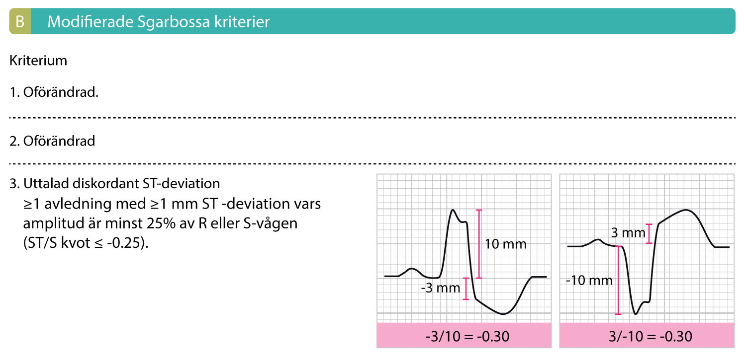Figur 1B. Modifierade Sgarbossakriterier innebär att det tredje kriteriet ersätts med ett kriterium där ST-deviationens amplitud ställs i relation till QRS-komplexets amplitud.