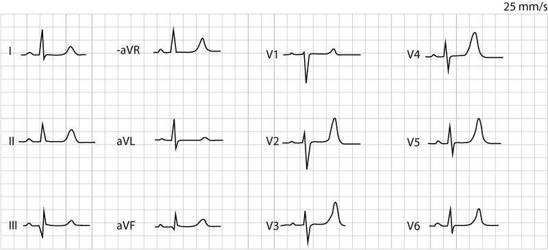 EKG som samtidigt visar höga smala T-vågor vid hyperkalemi och ett utdraget ST-segment vid hypokalcemi.