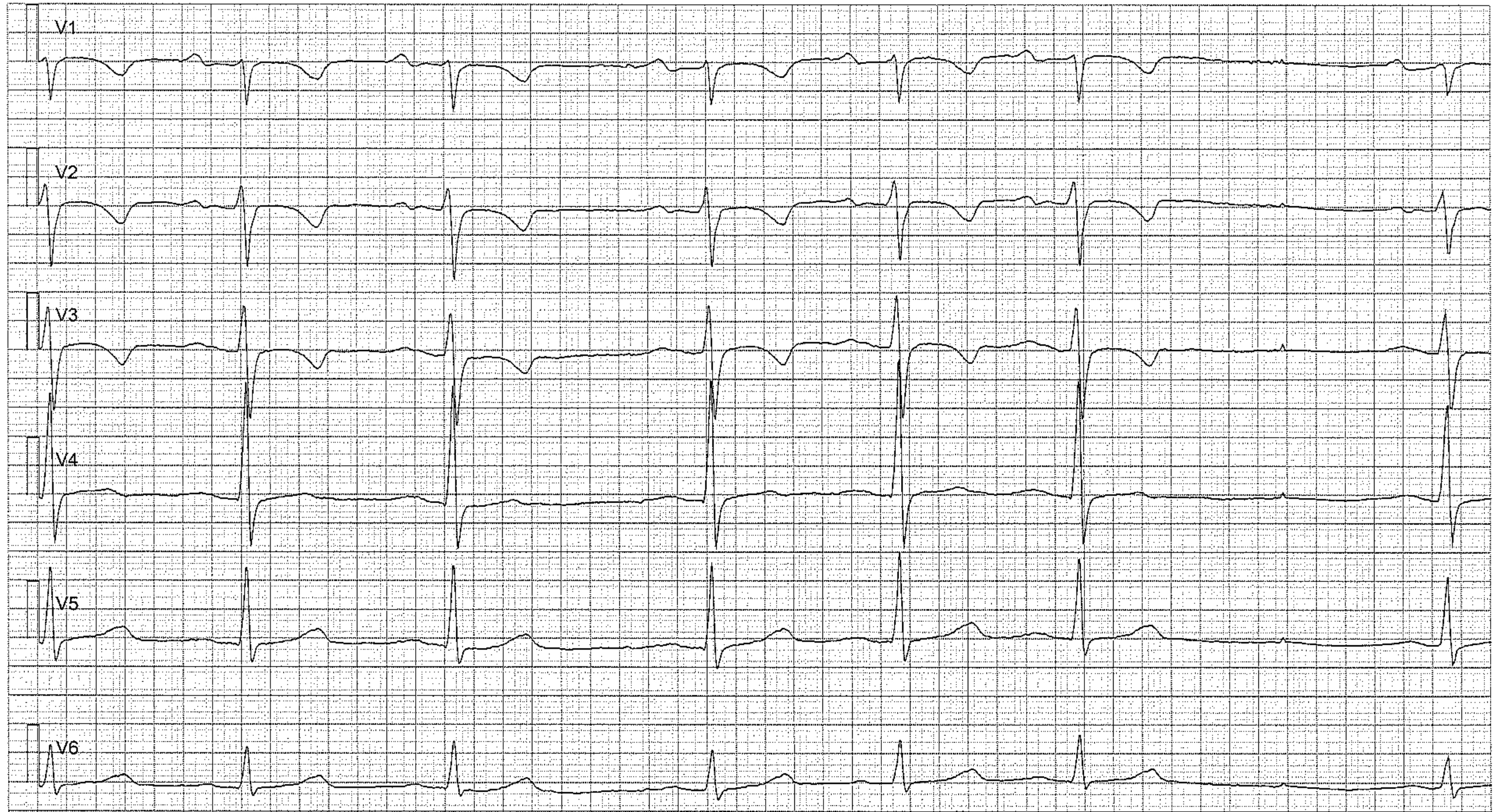 Figur 2. Sinusarytmi med sinuspaus. Negativa T-vågor är normalt i V1–V3 (patienten var 15 år gammal när EKG registrerades).