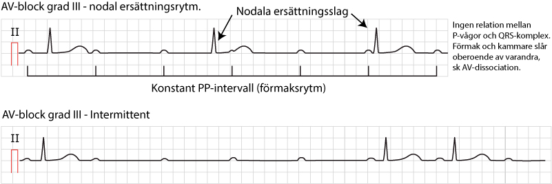 EKG med totalt AV-block, där P-vågor och QRS-komplex går oberoende av varandra.