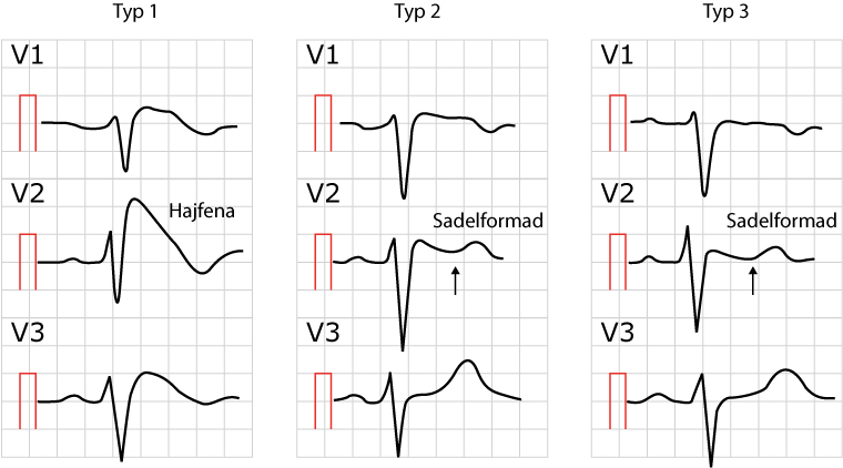 Figur 80. Brugada syndrom typ 1, typ 2 och typ 3.