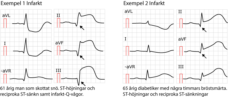 Exempel på ST-höjningsinfarkter (STEMI/STE-AKS). Notera att i båda dessa fall finns faktiskt patologiska Q-vågor (pilar), vilket antingen är gamla infarkter eller så har detta EKG registrerats flera timmar efter symptomdebuten.