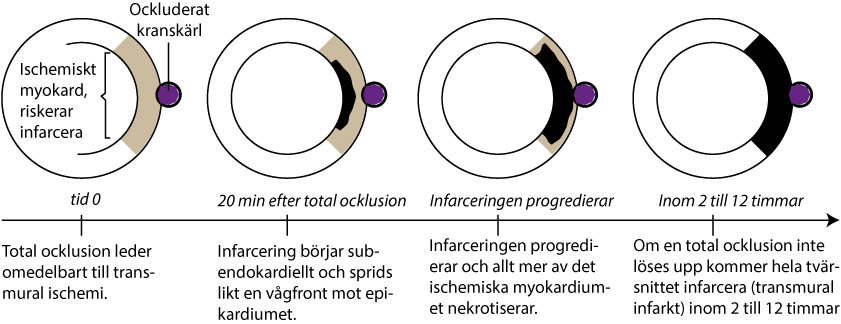 Figur 66. Förloppet från total ocklusion till transmural infarkt.