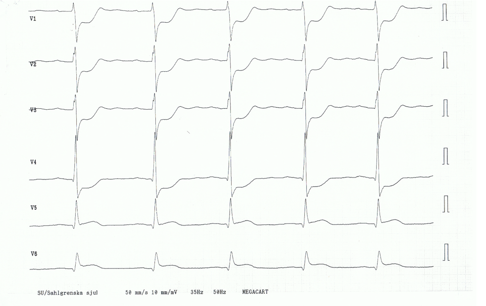 STEMI