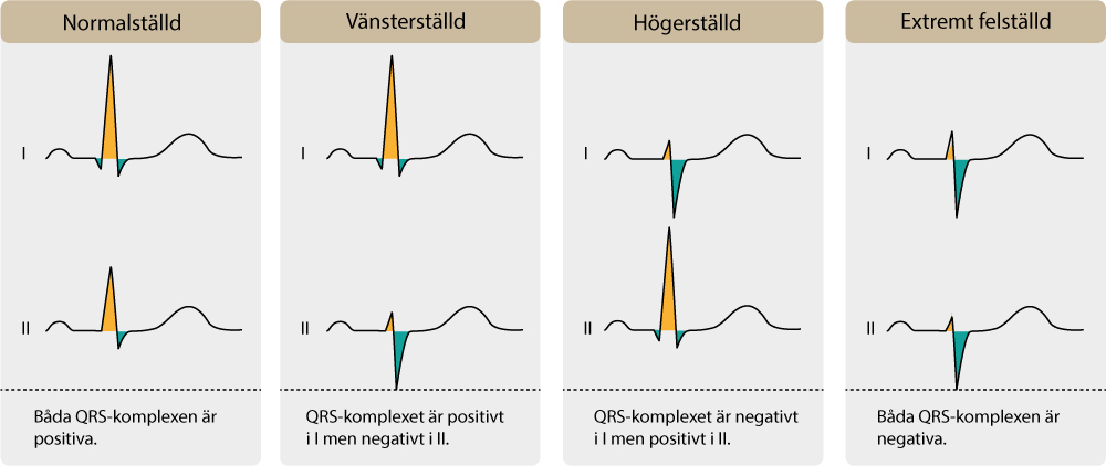 Figur 37. Bestämning av el-axel med hjälp av QRS-areal i avledning I och II.