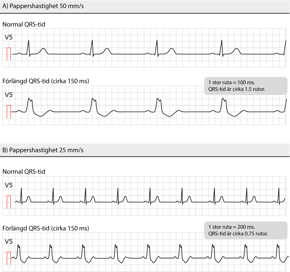 Figur 26. Exempel på breda QRS-komplex. Detta är exakt samma EKG-remsa med två olika pappershastigheter. I Sveriges används 50 mm/s i de flesta situationer.