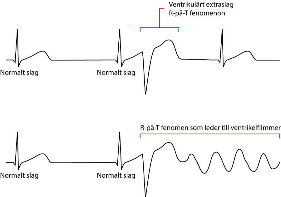 Figur 6 B. R-på-T fenomen
