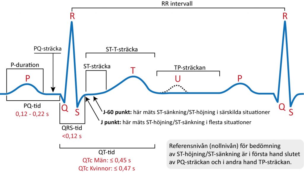 Figur 19. Den klassiska EKG-kurvan. Kammarkomplexet kallas även QRS-komplex, oavsett om det saknas någon av komponenterna i QRS.