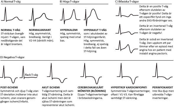 ekg tolkning ekg tolkning