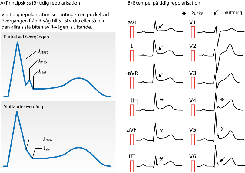 Figur 75. Early repolarization (tidig repolarisation).