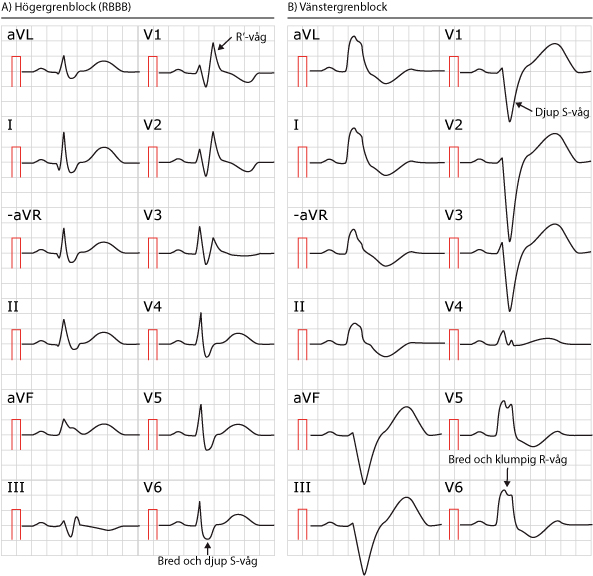 x-RBBB-o-LBBB Figur 99. Högergrenblock och vänstergrenblock.