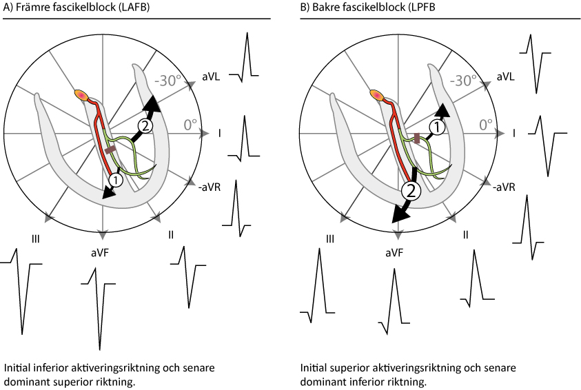 Figur 100. Främre och bakre fascikelblock. Delvis efter GS Wagner (Marriott's Practical Electrocardiography, Elsevier 2007) och AL Goldberg (Clinical Electrocardiography: A Simplified Approach, Elsevier Mosby 2006).