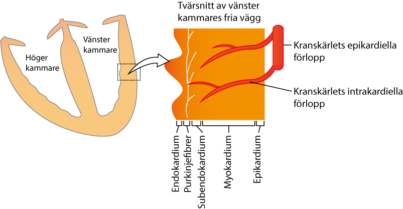 Figur 65. Vid NSTE-AKS är ocklusionen partiell och då kvarstår visst flöde i kranskärlet. Ischemin drabbar då subendokardiumet eftersom detta område har sämst förutsättningar vid ischemi. Subendokardiet kan nämligen inte tillgodogöra sig syreriktblod från kammarkaviteten (vilket endokardiet kan i viss mån) och syremängden i blodet som kommer från kranskärlet är reducerad eftersom det extraheras syre under kärlets förlopp genom myokardiet. Vid STE-AKS är ocklusionen total och då drabbas hela tvärsnittet av ischemi.